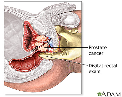 Prostate cancer Prostate cancer