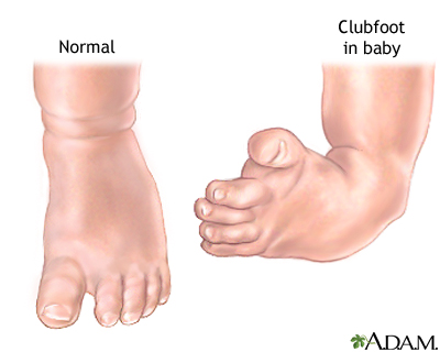 Clubfoot repair - series Clubfoot repair - series