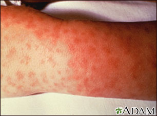 Rocky mountain spotted fever - lesions on arm Rocky mountain spotted fever - lesions on arm