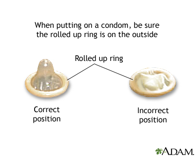 Condom application - series Condom application - series