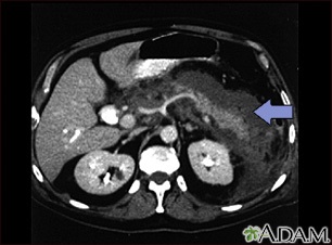 Pancreatitis, acute - CT scan