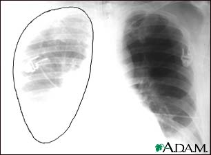 Aortic rupture - chest X-ray Aortic rupture - chest X-ray