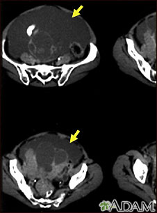 Ascites with ovarian cancer - CT scan Ascites with ovarian cancer - CT scan