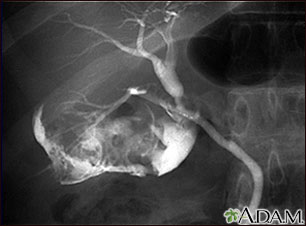 Cholecystitis - cholangiogram Cholecystitis - cholangiogram