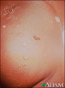 Impetigo - bullous on the buttocks