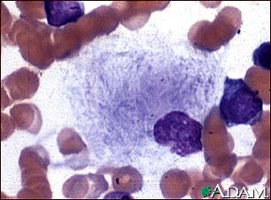 Gaucher cell - photomicrograph Gaucher cell - photomicrograph