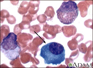 Waldenström Waldenström