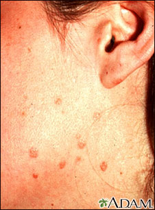 Warts - flat on the cheek and neck