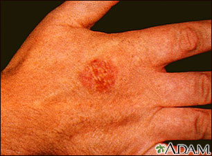 Bowen's disease on the hand Bowen's disease on the hand