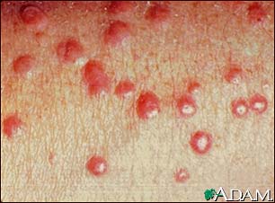 Xanthoma, eruptive - close-up Xanthoma, eruptive - close-up