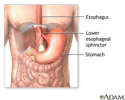 Gastroesophageal reflux - series Gastroesophageal reflux - series