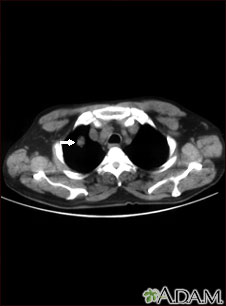 Pulmonary nodule, solitary - CT scan Pulmonary nodule, solitary - CT scan