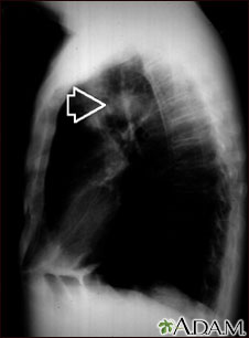 Pulmonary mass - side view chest X-ray Pulmonary mass - side view chest X-ray