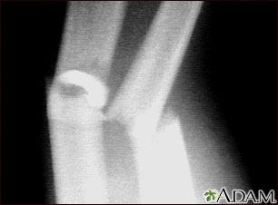 Fracture, forearm - X-ray Fracture, forearm - X-ray