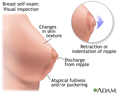 Breast self-exam Breast self-exam