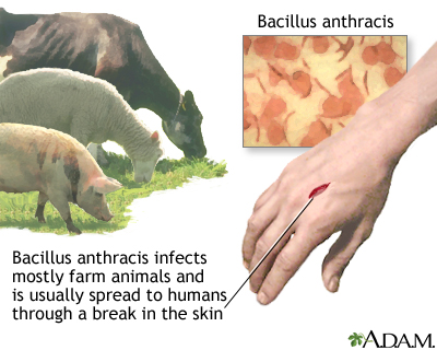 Cutaneous anthrax Cutaneous anthrax