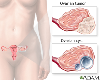 Ovarian growth worries Ovarian growth worries