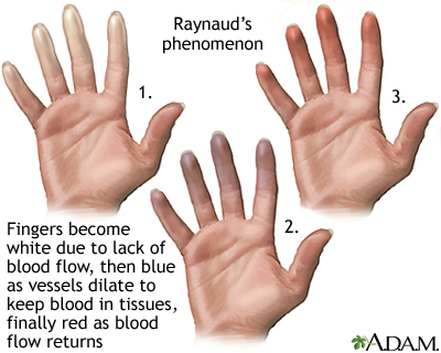 Raynaud's phenomenon Raynaud's phenomenon