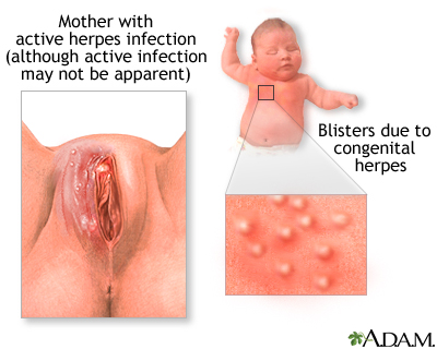 Congenital herpes Congenital herpes