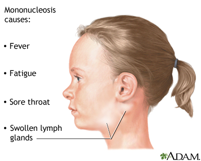 Infectious mononucleosis Infectious mononucleosis