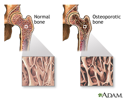 Osteoporosis Osteoporosis
