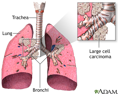 Large cell carcinoma Large cell carcinoma
