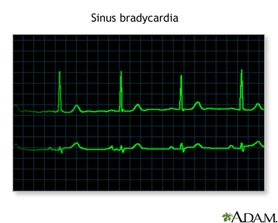 Bradycardia Bradycardia