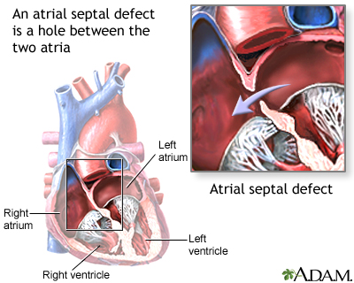 Atrial septal defect