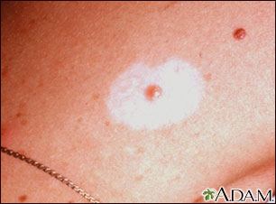 Halo nevus Halo nevus