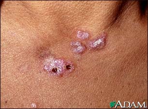 Lupus, discoid - view of lesions on the chest Lupus, discoid - view of lesions on the chest