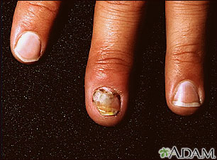 Nail infection - candidal Nail infection - candidal