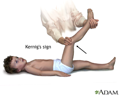 Kernig's sign of meningitis Kernig's sign of meningitis