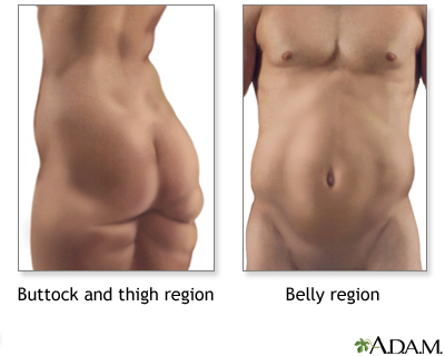 Liposuction - series - Indications Liposuction - series - Indications