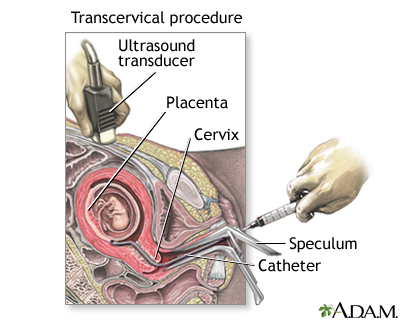 Procedure, part 2 - transcervical Procedure, part 2 - transcervical