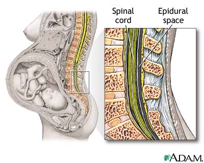 Epidural - series