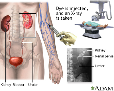 Intravenous pyelogram (IVP) Intravenous pyelogram (IVP)