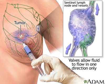 Sentinel node biopsy