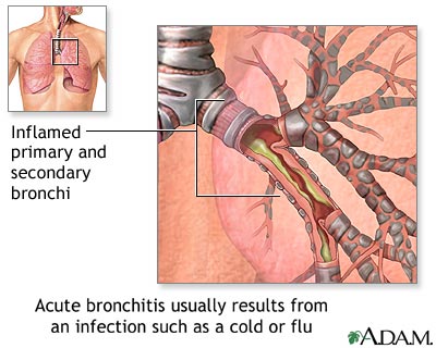 Causes of acute bronchitis Causes of acute bronchitis