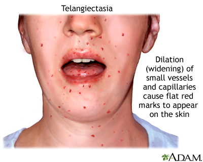 Telangiectasia Telangiectasia