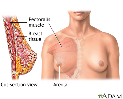 Breast augmentation - series - Normal anatomy Breast augmentation - series - Normal anatomy