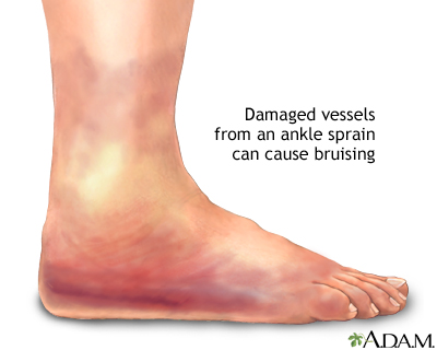 Ankle sprain swelling Ankle sprain swelling