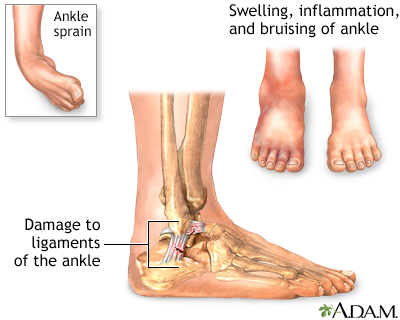 Ankle sprain Ankle sprain