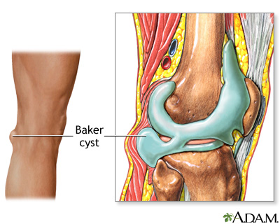 Baker cyst