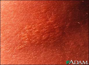 Xanthoma - close-up Xanthoma - close-up