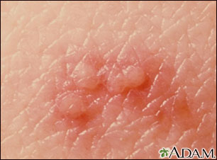 Herpes zoster (shingles) - close-up of lesion Herpes zoster (shingles) - close-up of lesion