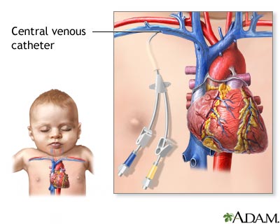 Central venous catheter Central venous catheter