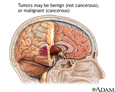 Brain tumor Brain tumor
