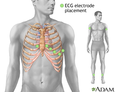 ECG electrode placement ECG electrode placement