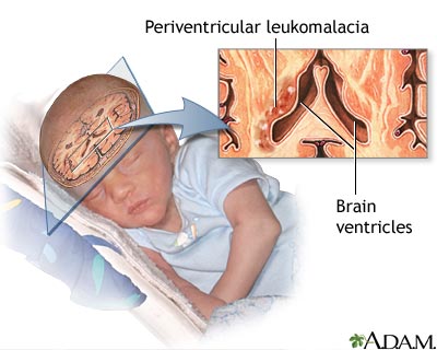 Periventricular leukomalacia Periventricular leukomalacia