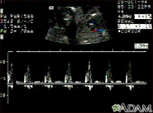 Ultrasound, ventricular septal defect - heartbeat Ultrasound, ventricular septal defect - heartbeat